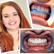 Patient before during and after teeth whitening
