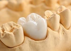 Model of the mouth with a dental crown covering one tooth