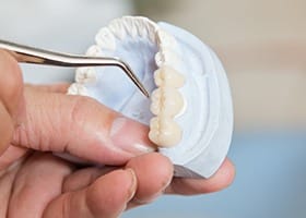 Model of the mouth with a dental bridge over three teeth