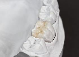 Model of a tooth with an onlay restoration