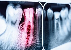 Dental x ray of root canal treated tooth