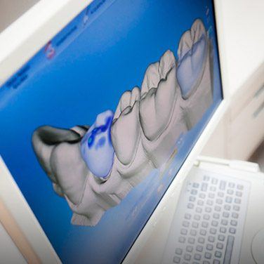 Digital impressions of teeth on computer screen