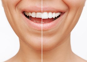Close up of smile before and after getting dental veneers in Oklahoma City