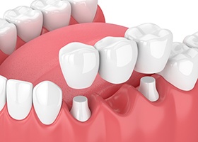 Digital illustration of dental bridge 