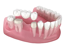 Traditional dental bridge 