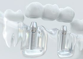 Implant dental bridge 