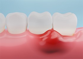 close-up of red, swollen gums 